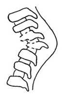 Выпуклость (горб) вследствие разрушения позвонков при туберкулезе.