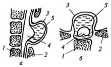 Грыжа спинномозговых оболочек (миелодисплазия, spina bifida).