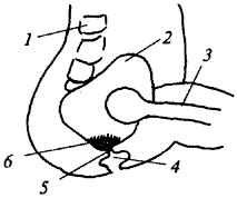 Остеомиелит седалищного бугра тазовой кости (боковой разрез).