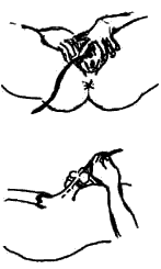 Катетеризация женщины и мужчины.