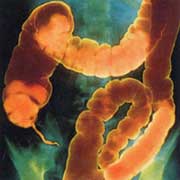 Рентгенограмма толстого кишечника.